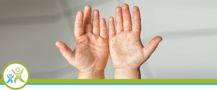 Hand Foot & Mouth Disease in Children Near Me Hand Foot & Mouth Disease in Children Near Me