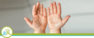 Hand Foot & Mouth Disease in Children Near Me Hand Foot & Mouth Disease in Children Near Me