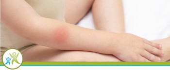 Pediatric Burns Treatment Specialist Near Me in Kirkland, WA