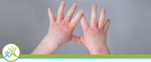 Hand, Foot and Mouth Disease Treatment Specialist Near Me in Kirkland, WA Hand, Foot and Mouth Disease Treatment Specialist Near Me in Kirkland, WA